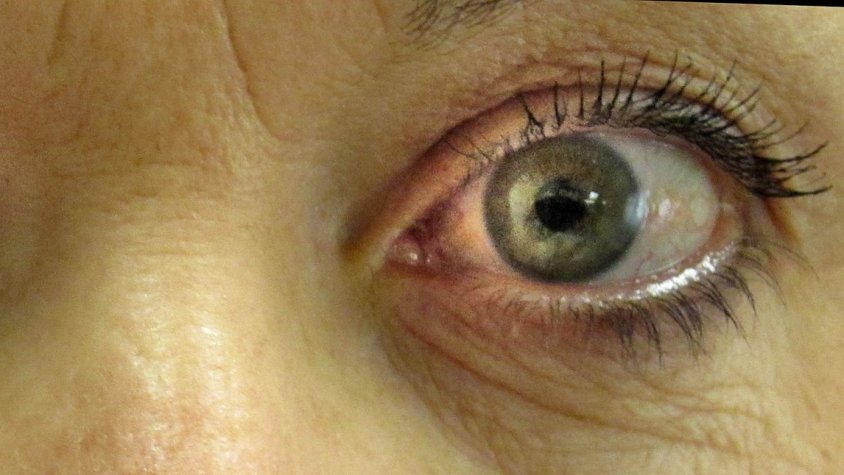 Atenció al  glaucoma