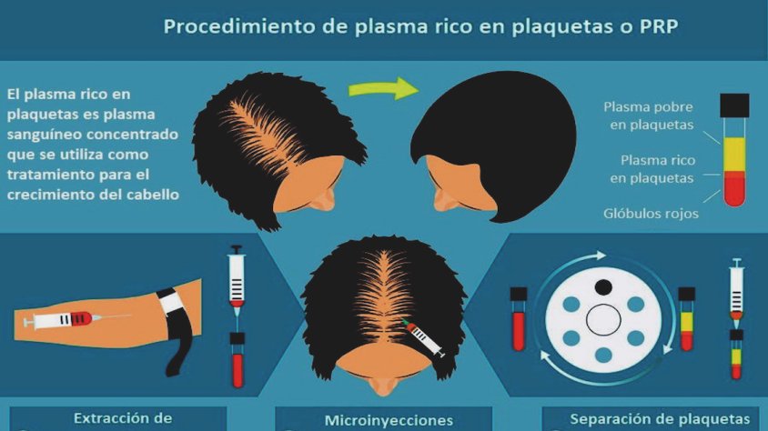 Tractament científic contra la calvície. És un  tractament clínic d’un centre mèdic conegut